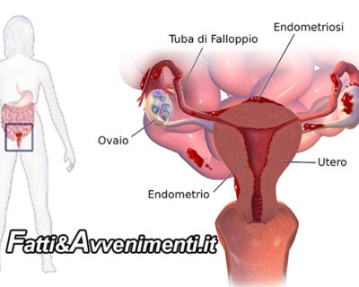 Salute & Benessere. Endometriosi: sintomi trattamenti prognosi